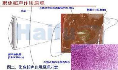 子宫肌瘤8公分要做开腹手术吗,子宫肌瘤加宫颈囊肿要子宫全切吗