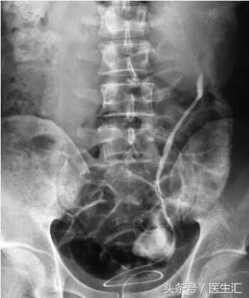 左输尿管上段结石伴左肾积水,左肾盂输尿管连接处狭窄重度积水