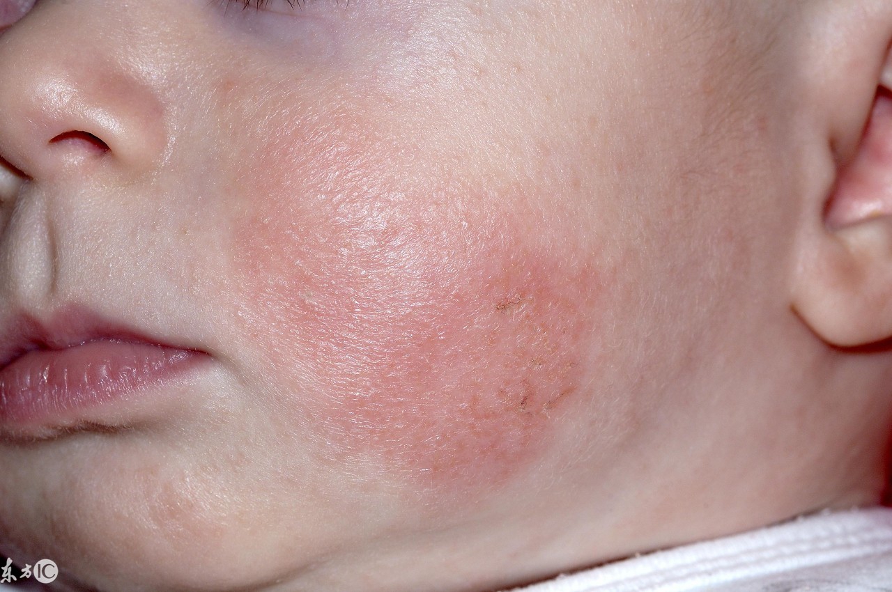 宝宝湿疹擦了很多药没好怎么办,宝宝湿疹护理实操