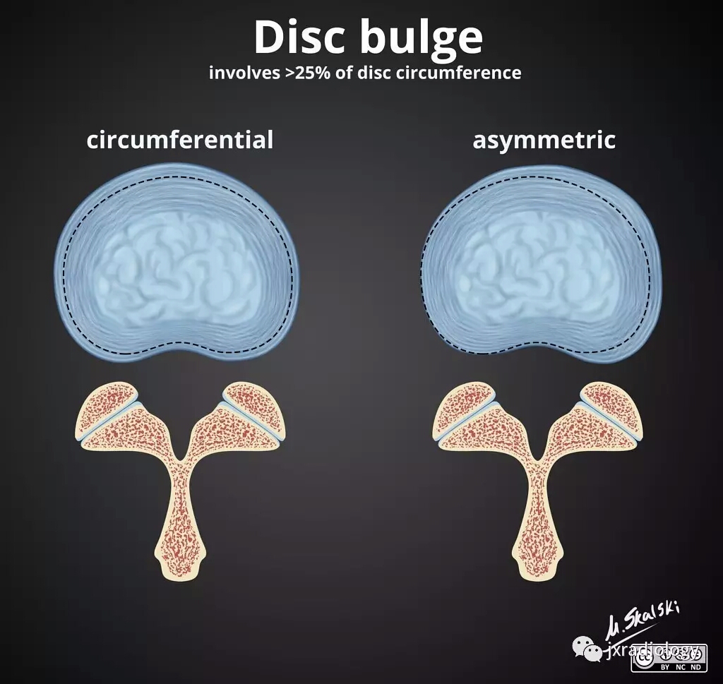 腰椎间盘怎么判断膨出还是突出,腰椎间盘膨出的最佳锻炼方法图