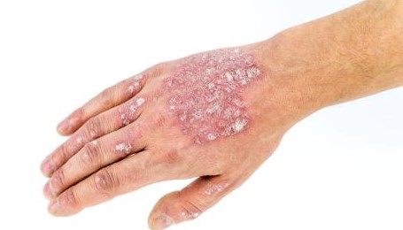 糖皮质激素的抗炎作用机制图解,糖皮质激素可以抗休克吗