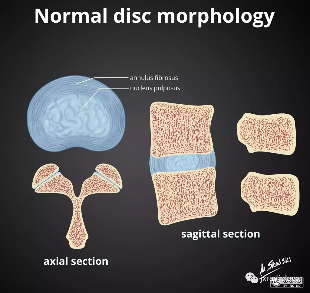 腰椎间盘怎么判断膨出还是突出,腰椎间盘膨出的最佳锻炼方法图
