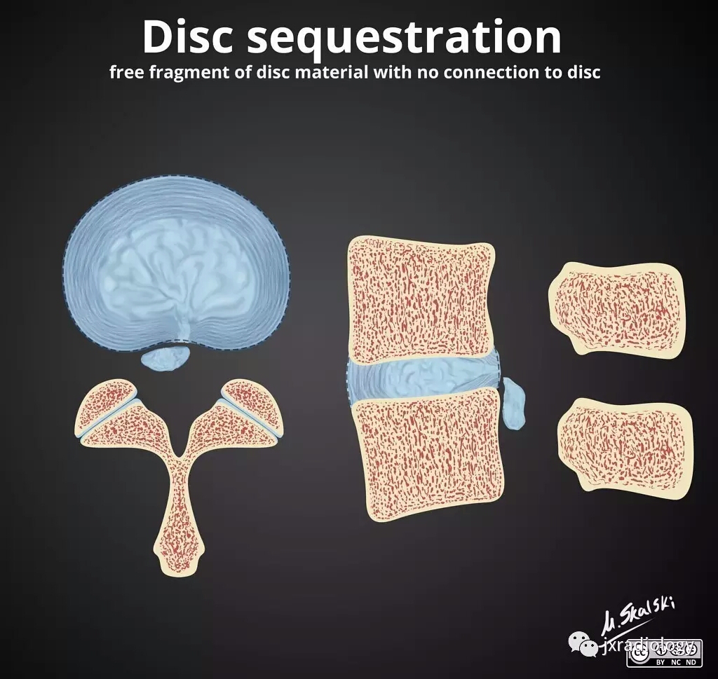 腰椎间盘怎么判断膨出还是突出,腰椎间盘膨出的最佳锻炼方法图