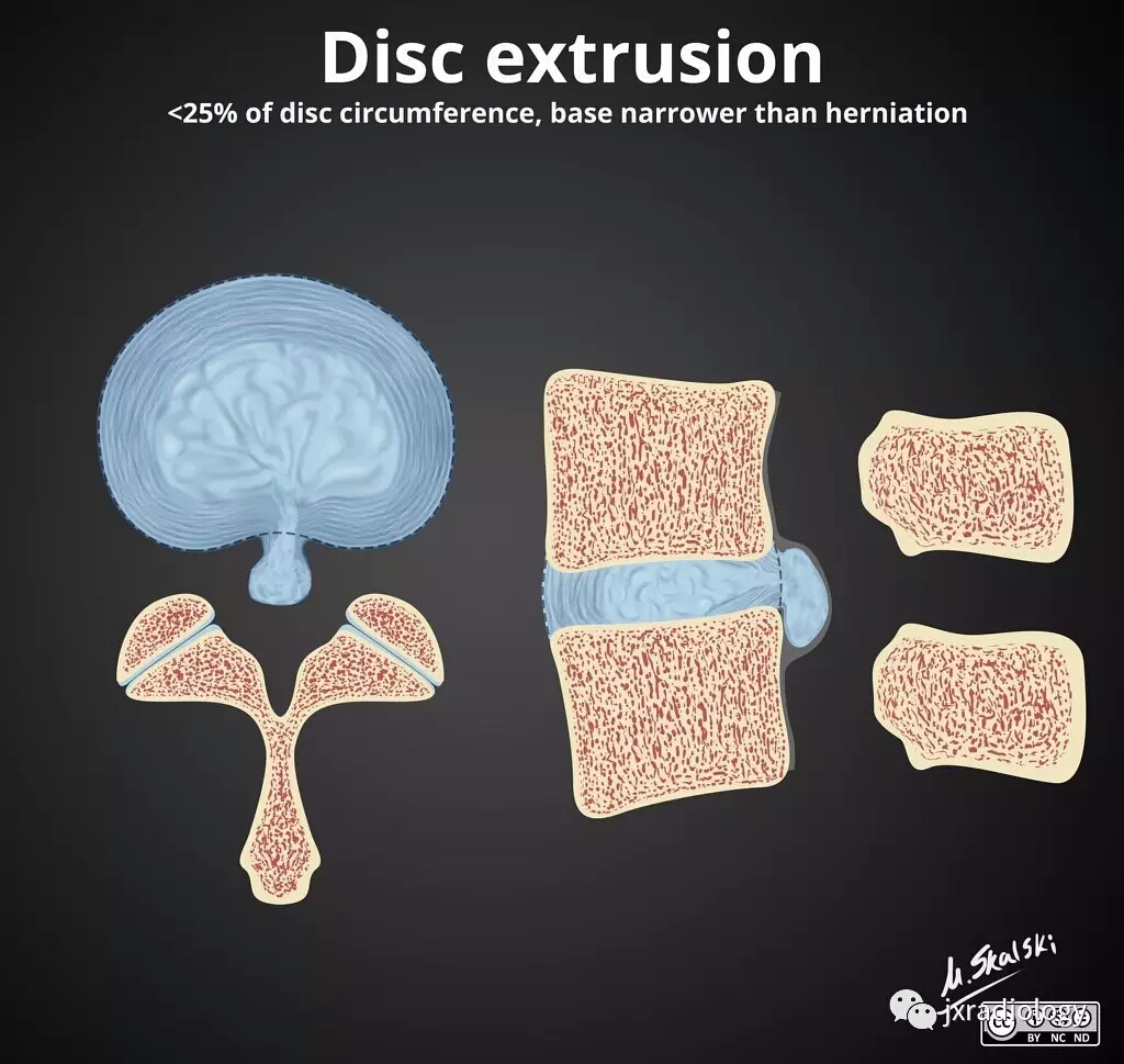 腰椎间盘怎么判断膨出还是突出,腰椎间盘膨出的最佳锻炼方法图