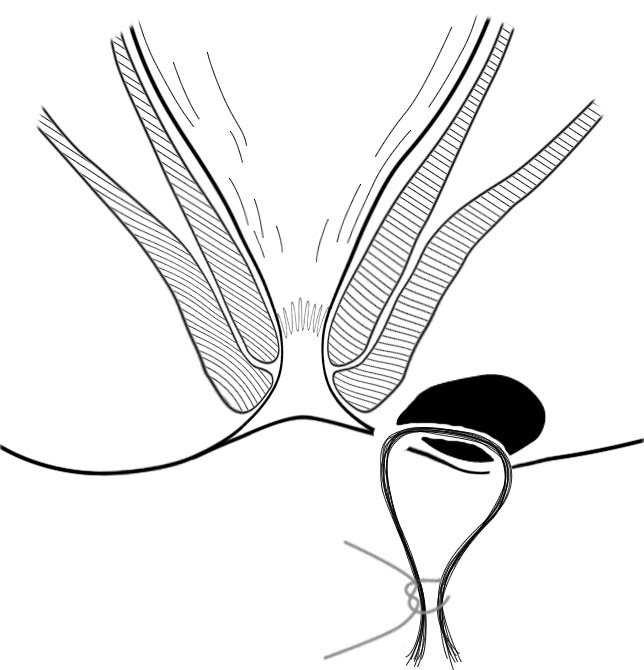 肛肠最新技术,人活一世难免会遇到各种糟心的事