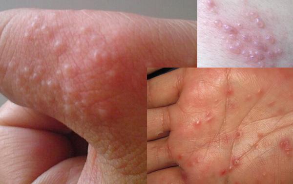 冬天手痒里面有小水泡加脱皮,中医手上起小水泡很痒怎么办