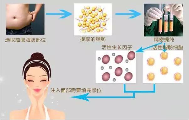 脂肪移植术后需要关注什么,自体脂肪移植填充泪沟多久恢复
