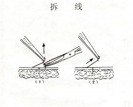 产妇侧切多久可以拆线,产妇侧切缝合线需要拆线吗