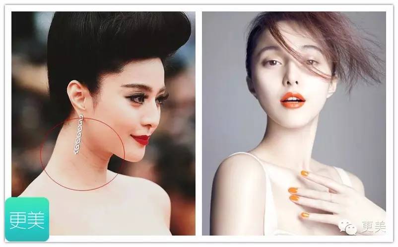 瘦脸针只打一针管用吗,瘦脸针只瘦咬肌吗