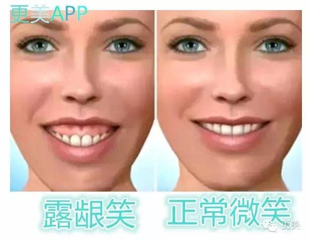 瘦脸针只打一针管用吗,瘦脸针只瘦咬肌吗