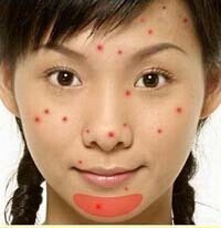 痘痘是身体什么地方出了问题,痘痘告诉你哪里生病了