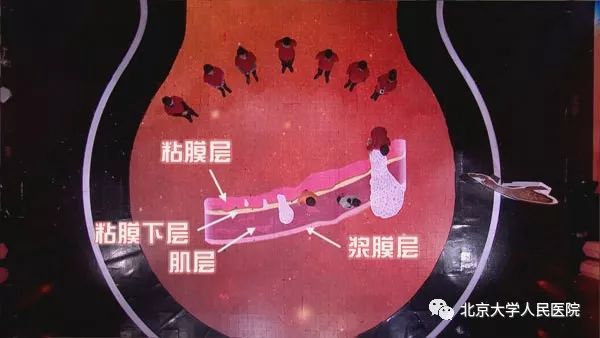 医生教授讲解胃癌,消化科医生讲述胃癌