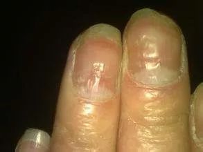 小指甲特别小,小指甲小到什么程度