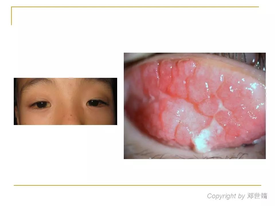 眼睛过敏如何预防,治疗眼周围过敏方法