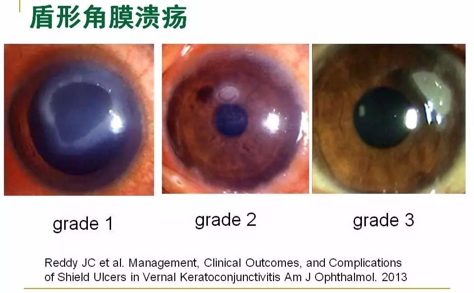 眼睛过敏如何预防,治疗眼周围过敏方法