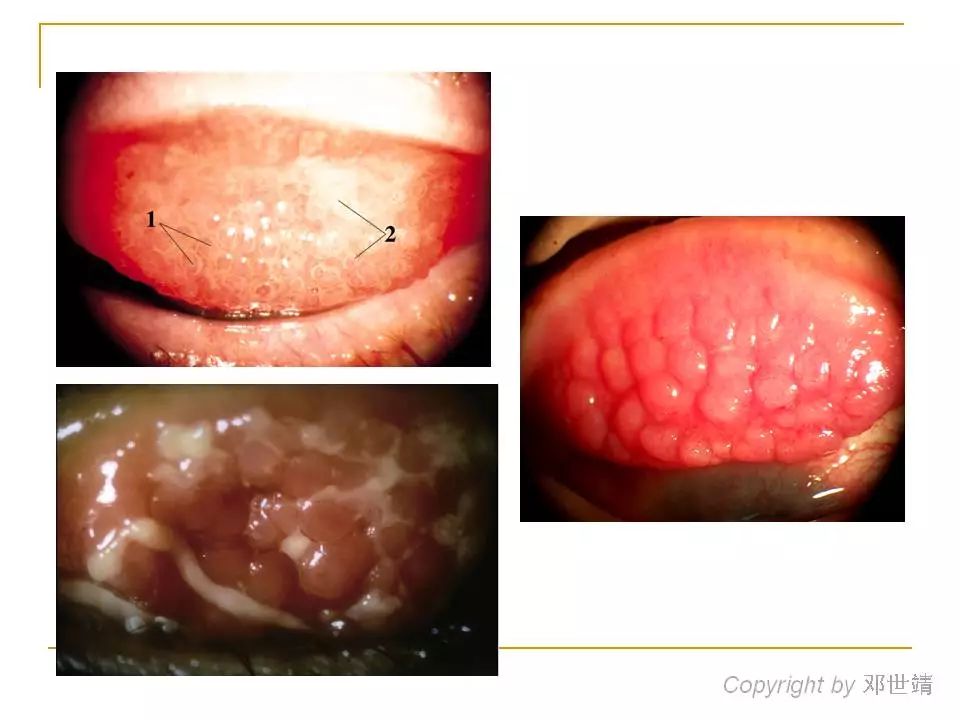 眼睛过敏如何预防,治疗眼周围过敏方法