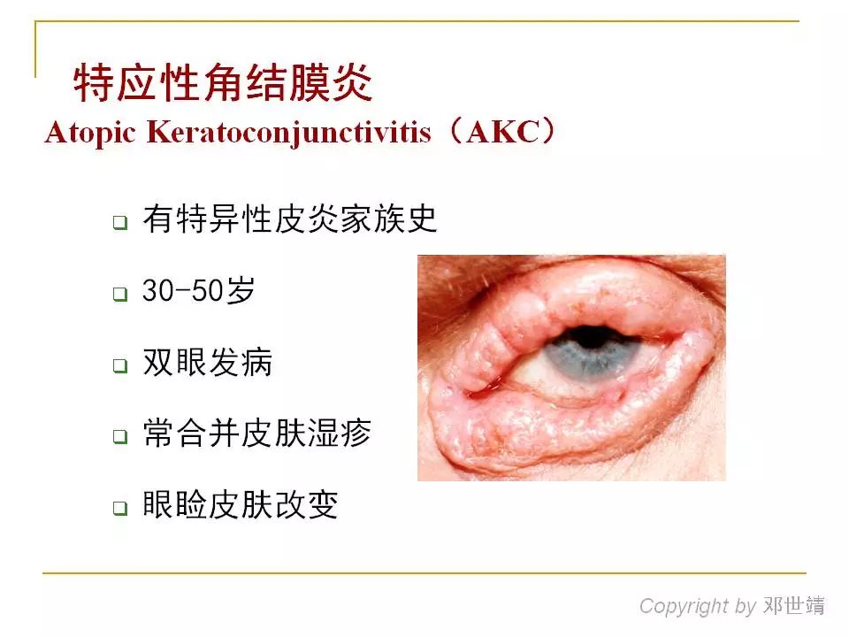 眼睛过敏如何预防,治疗眼周围过敏方法