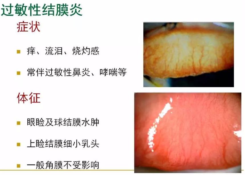 眼睛过敏如何预防,治疗眼周围过敏方法