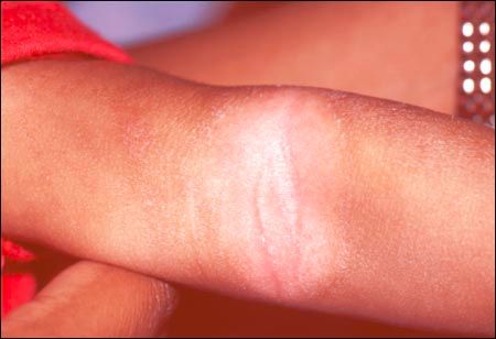 宝宝湿疹最实用的解决方法,治疗婴儿湿疹三个立竿见影的理念