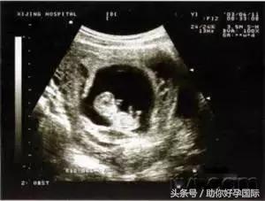 助你好孕,孕早期肚子隐隐作痛出血