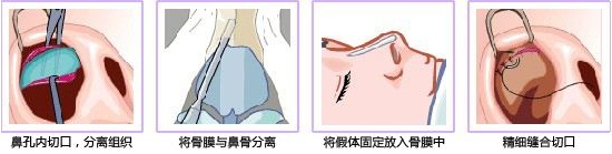 情人节“*力暴**亲热”！做过隆鼻后会被撞歪？