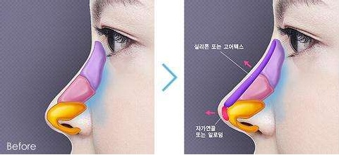 情人节“*力暴**亲热”！做过隆鼻后会被撞歪？