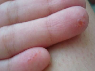 冬天手痒里面有小水泡加脱皮,中医手上起小水泡很痒怎么办