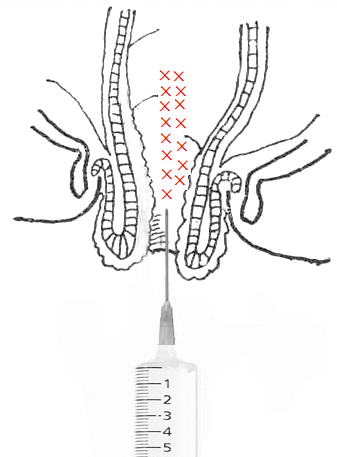 酸可收敛，涩可固脱，注射固脱技术让懂的人明白，医学需要创意