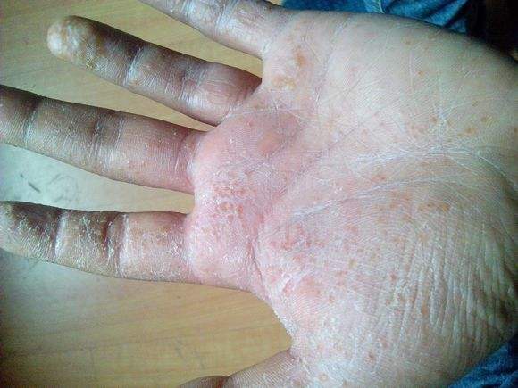 冬天手痒里面有小水泡加脱皮,中医手上起小水泡很痒怎么办