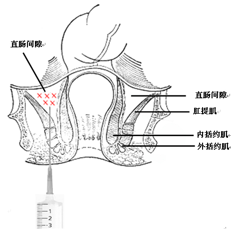 酸可收敛，涩可固脱，注射固脱技术让懂的人明白，医学需要创意