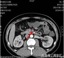 间歇性反酸、腹痛、呕吐咖啡色液体