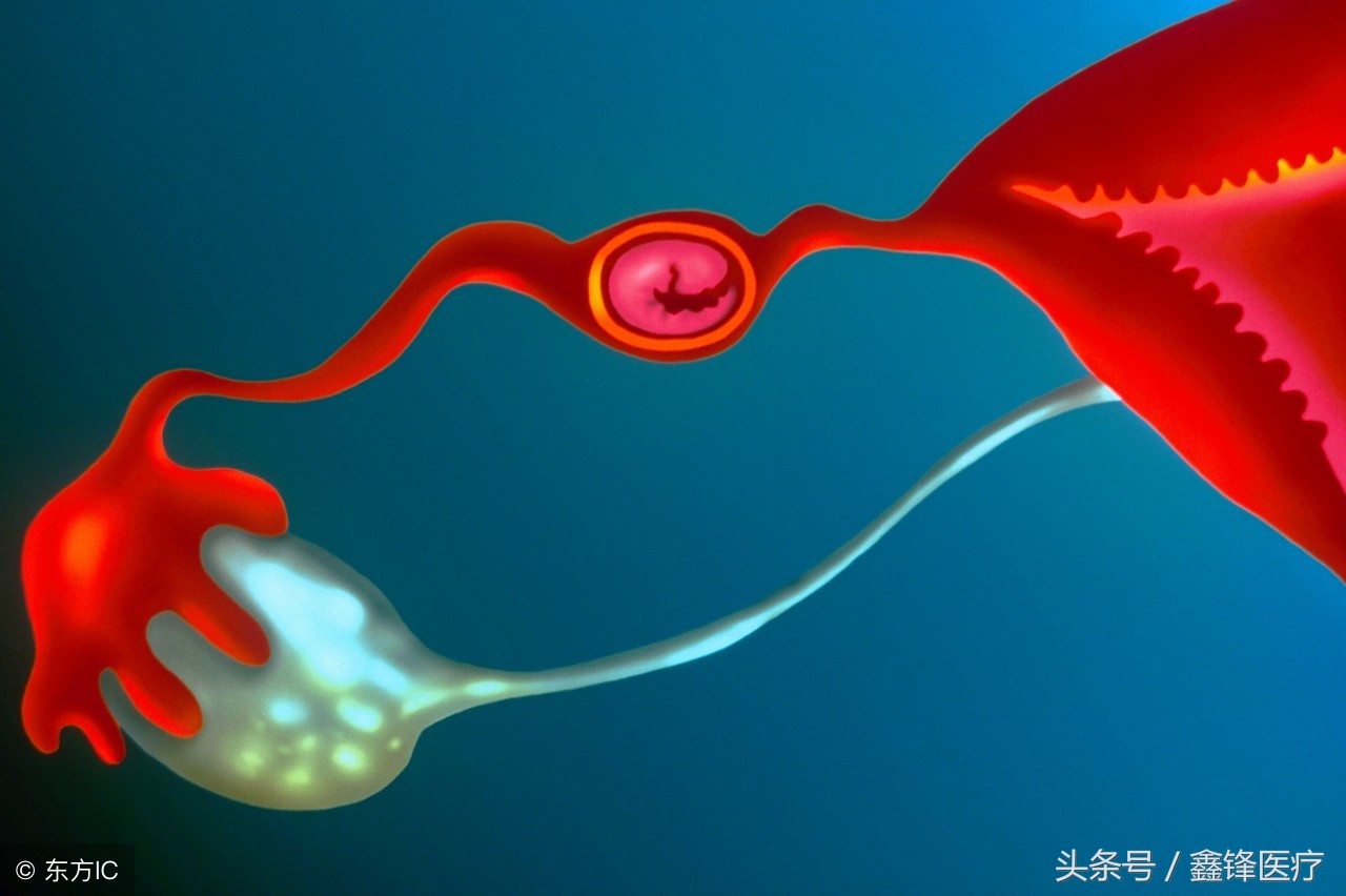 关于宫外孕病因的相关介绍,有关宫外孕的发病原因介绍