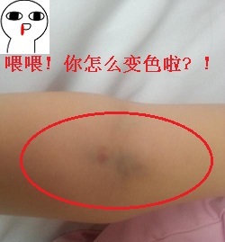 抽完血之后胳膊细了一圈,抽了血手臂发紫一个礼拜了