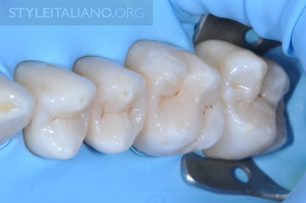 后牙修补贴片,后牙全瓷修复图片