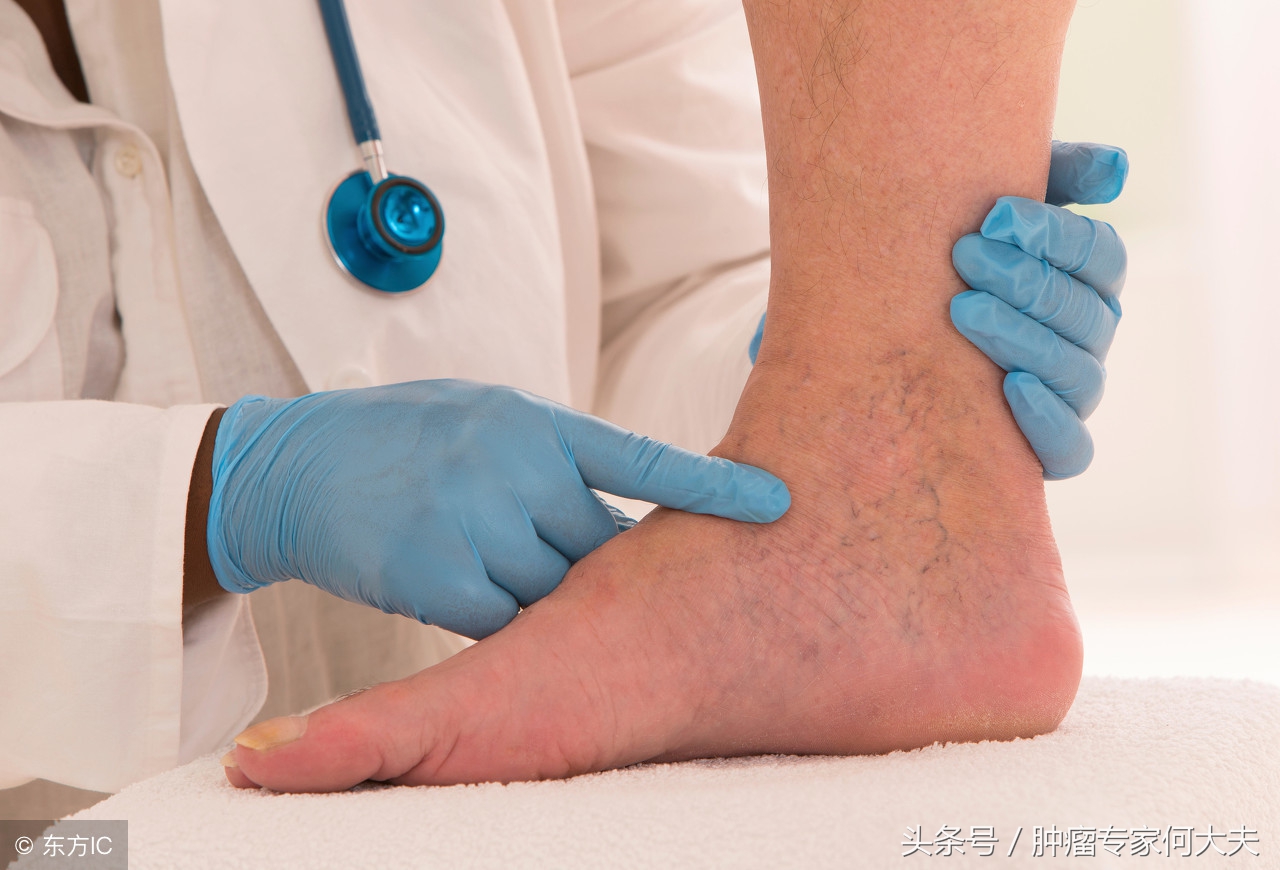 腿肿的厉害检查是肺癌,腿肿是肺癌的前兆吗