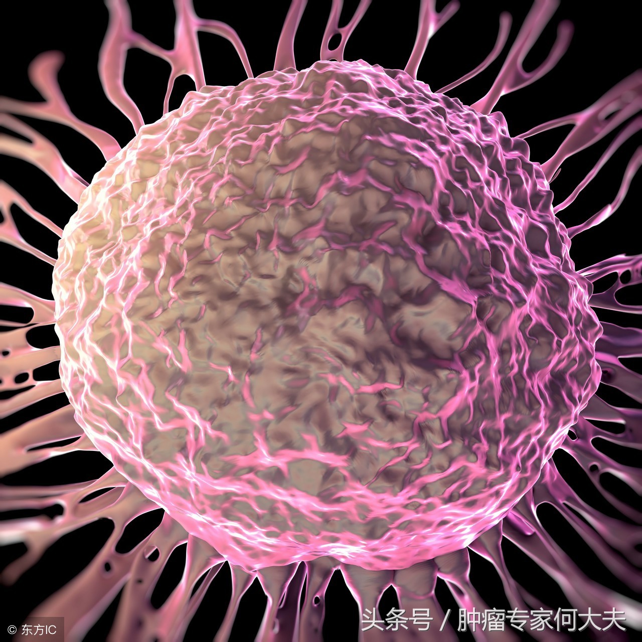 腿肿的厉害检查是肺癌,腿肿是肺癌的前兆吗