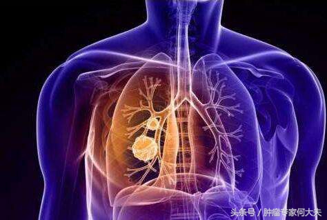 腿肿的厉害检查是肺癌,腿肿是肺癌的前兆吗