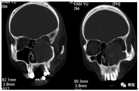 73岁患者因左鼻塞流脓涕4个月入院，CT发现一软组织高低混杂密度，怎么诊断？