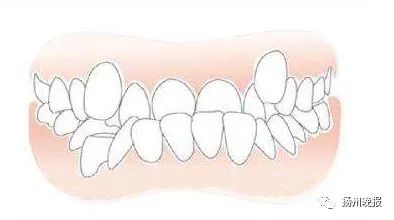 6岁小孩长双排牙齿需要拔吗,宝宝换牙期长出双排牙需要拔掉吗
