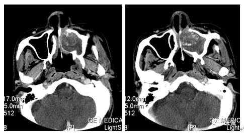 73岁患者因左鼻塞流脓涕4个月入院，CT发现一软组织高低混杂密度，怎么诊断？