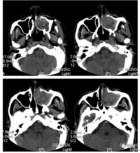 73岁患者因左鼻塞流脓涕4个月入院，CT发现一软组织高低混杂密度，怎么诊断？