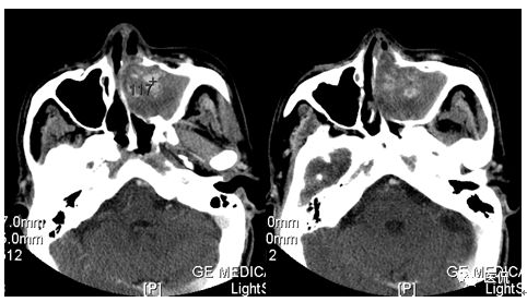 73岁患者因左鼻塞流脓涕4个月入院，CT发现一软组织高低混杂密度，怎么诊断？