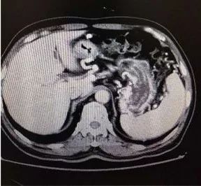 出血原因千千万，此例患者为哪般？