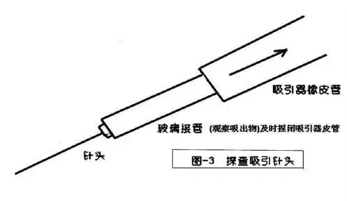 术后腹壁窦道怎样处理,腹部窦道手术怎么判断切除干净