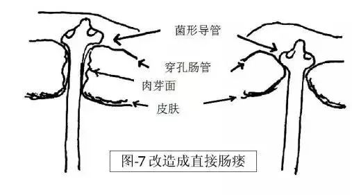 术后腹壁窦道怎样处理,腹部窦道手术怎么判断切除干净