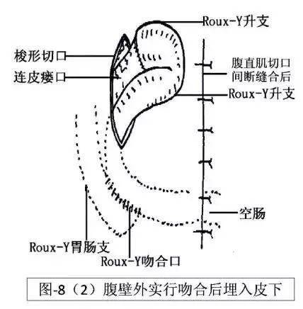 术后腹壁窦道怎样处理,腹部窦道手术怎么判断切除干净