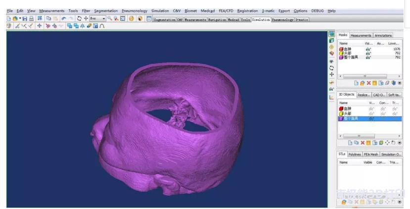 3D打印在脑出血治疗中的应用