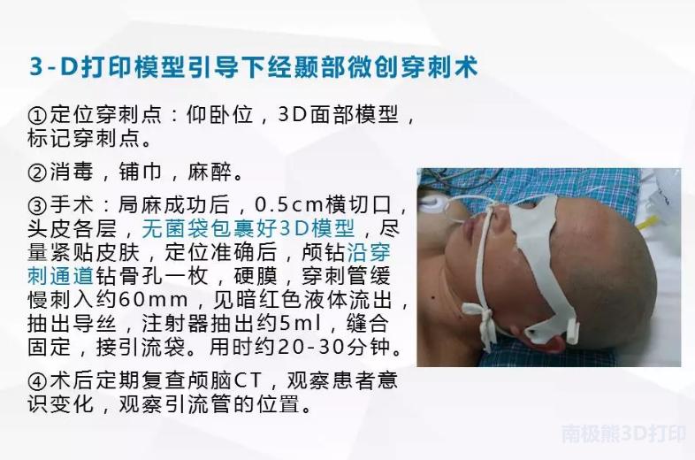 3D打印在脑出血治疗中的应用