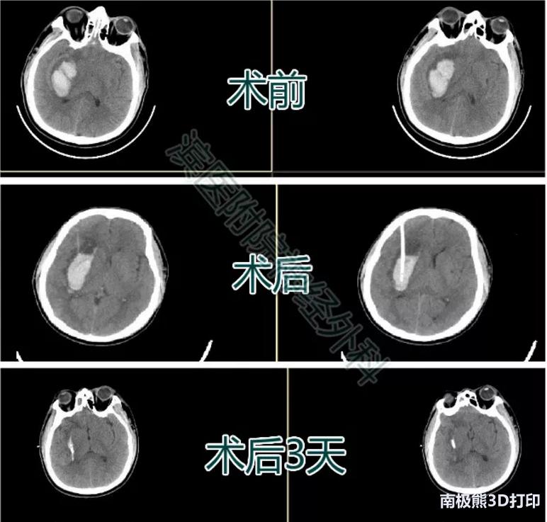 3D打印在脑出血治疗中的应用