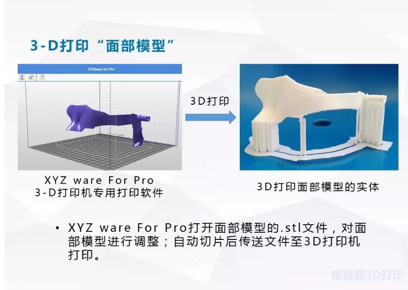 3D打印在脑出血治疗中的应用